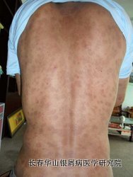银屑病症状