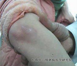 银屑病症状